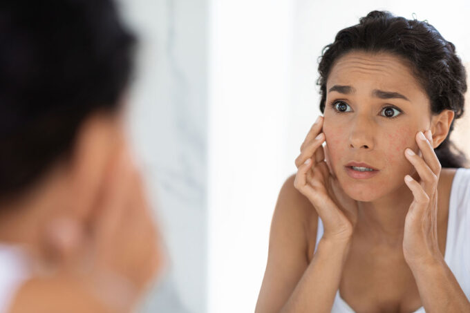 Period Acne Explained